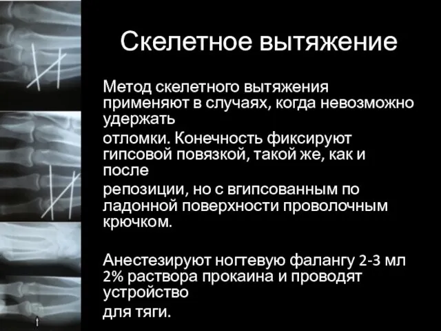 Скелетное вытяжение Метод скелетного вытяжения применяют в случаях, когда невозможно удержать