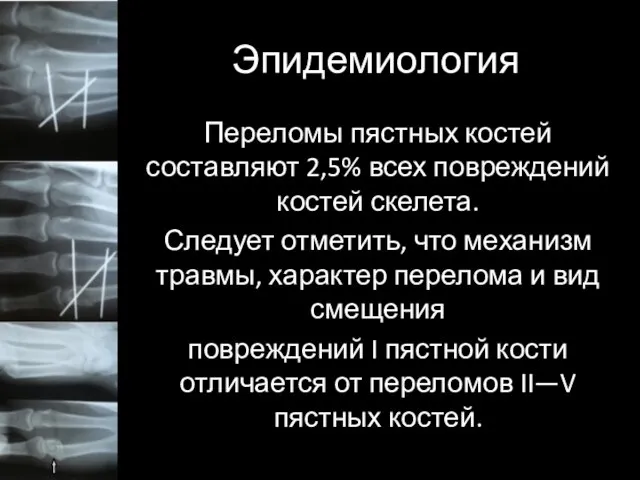 Эпидемиология Переломы пястных костей составляют 2,5% всех повреждений костей скелета. Следует