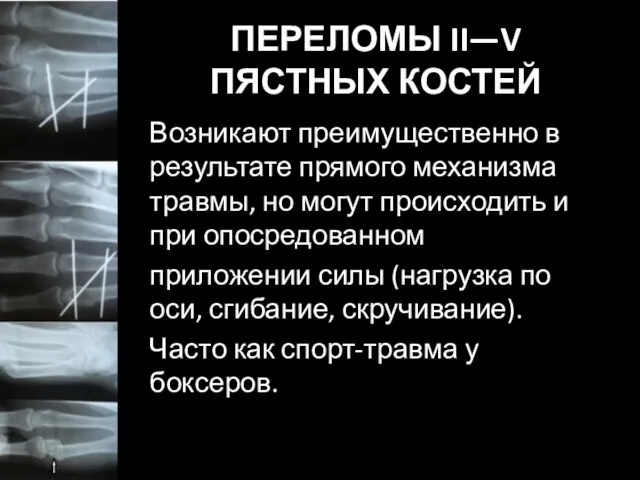 ПЕРЕЛОМЫ II—V ПЯСТНЫХ КОСТЕЙ Возникают преимущественно в результате прямого механизма травмы,