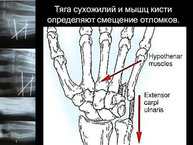 Тяга сухожилий и мышц кисти определяют смещение отломков.