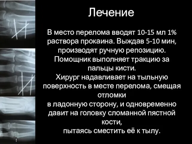 Лечение В место перелома вводят 10-15 мл 1% раствора прокаина. Выждав