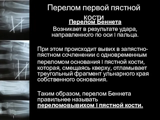 Перелом первой пястной кости Перелом Беннета Возникает в результате удара, направленного