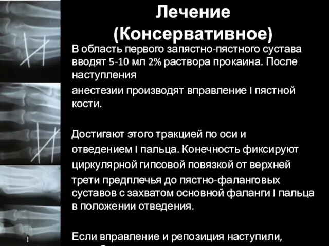 Лечение (Консервативное) В область первого запястно-пястного сустава вводят 5-10 мл 2%