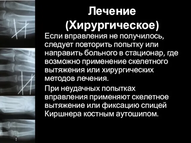 Лечение (Хирургическое) Если вправления не получилось, следует повторить попытку или направить