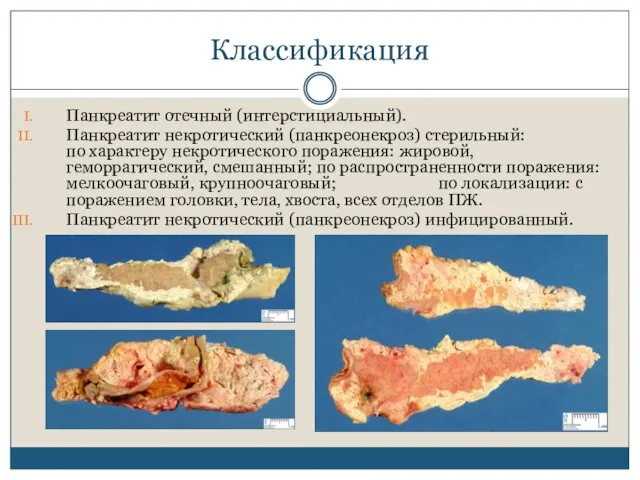 Классификация Панкреатит отечный (интерстициальный). Панкреатит некротический (панкреонекроз) стерильный: по характеру некротического