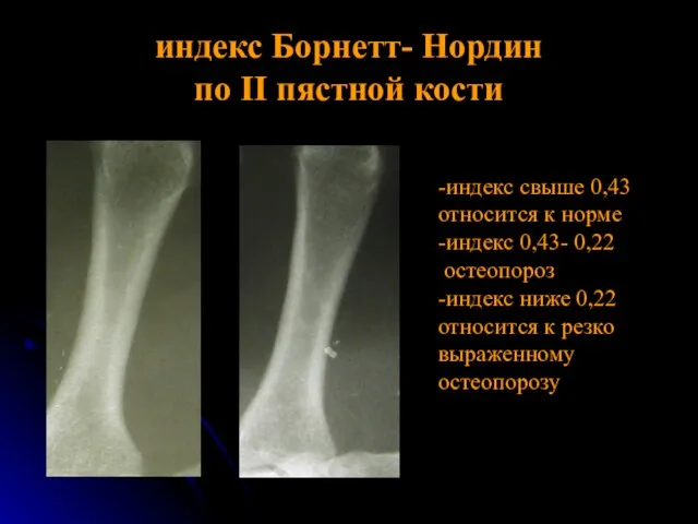 индекс Борнетт- Нордин по II пястной кости -индекс свыше 0,43 относится