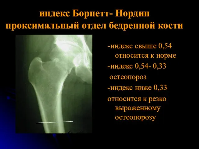 индекс Борнетт- Нордин проксимальный отдел бедренной кости -индекс свыше 0,54 относится