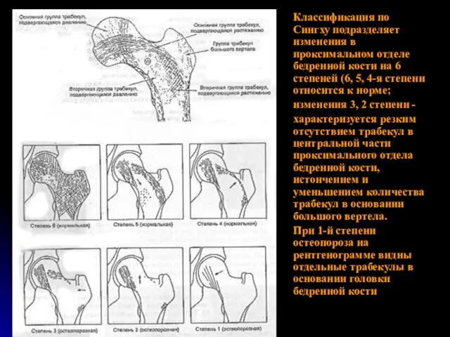 Классификация по Сингху подразделяет изменения в проксимальном отделе бедренной кости на