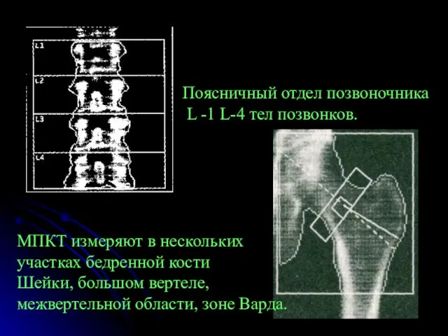 Поясничный отдел позвоночника L -1 L-4 тел позвонков. МПКТ измеряют в