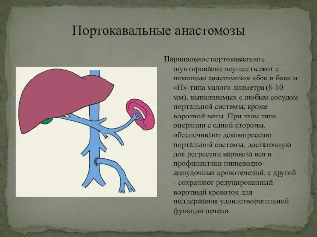 Портокавальные анастомозы Парциальное портокавалъное шунтирование осуществляют с помощью анастомозов «бок в