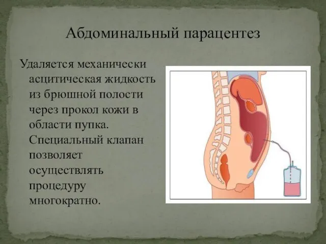 Абдоминальный парацентез Удаляется механически асцитическая жидкость из брюшной полости через прокол