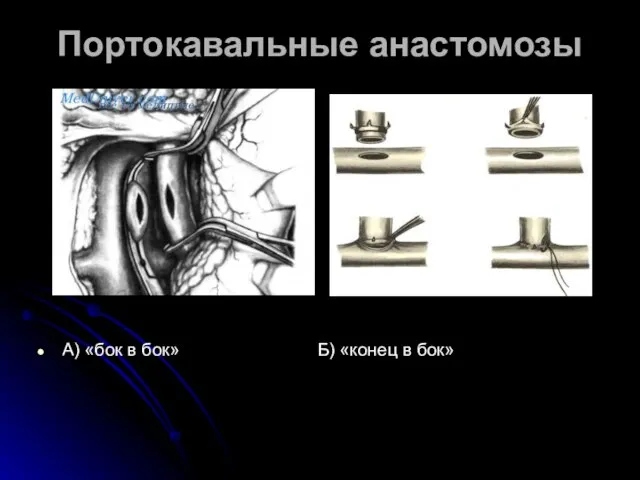 Портокавальные анастомозы А) «бок в бок» Б) «конец в бок»