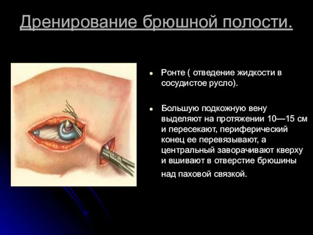 Дренирование брюшной полости. Ронте ( отведение жидкости в сосудистое русло). Большую