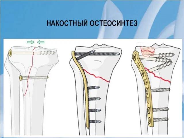 Накостный остеосинтез Костные фрагменты устанавливают в заданном положении, добиваясь точного сопоставления