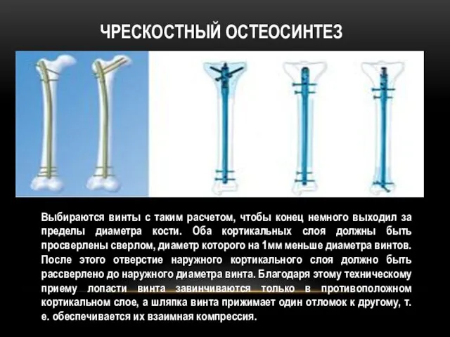 Чрескостный остеосинтез Выбираются винты с таким расчетом, чтобы конец немного выходил