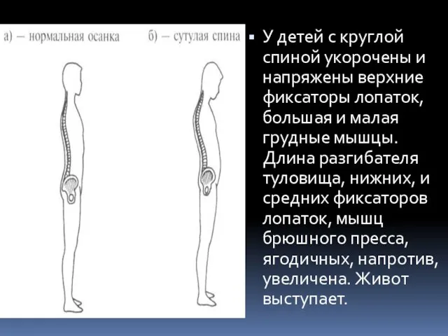 У детей с круглой спиной укорочены и напряжены верхние фиксаторы лопаток,