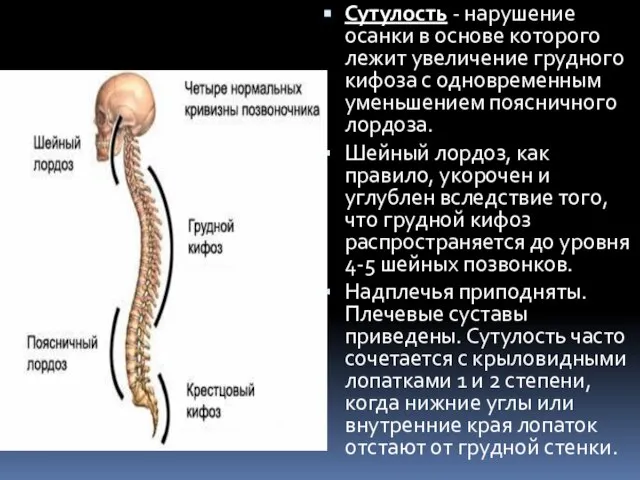 Сутулость - нарушение осанки в основе которого лежит увеличение грудного кифоза