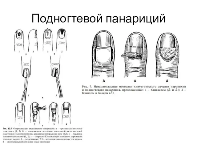 Подногтевой панариций