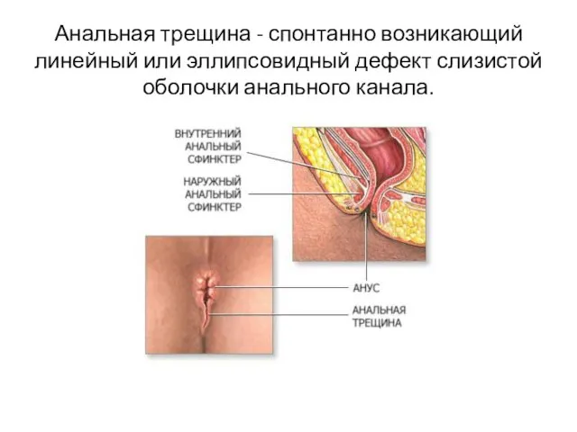 Анальная трещина - спонтанно возникающий линейный или эллипсовидный дефект слизистой оболочки анального канала.