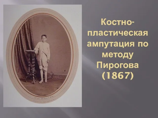 Костно-пластическая ампутация по методу Пирогова (1867)