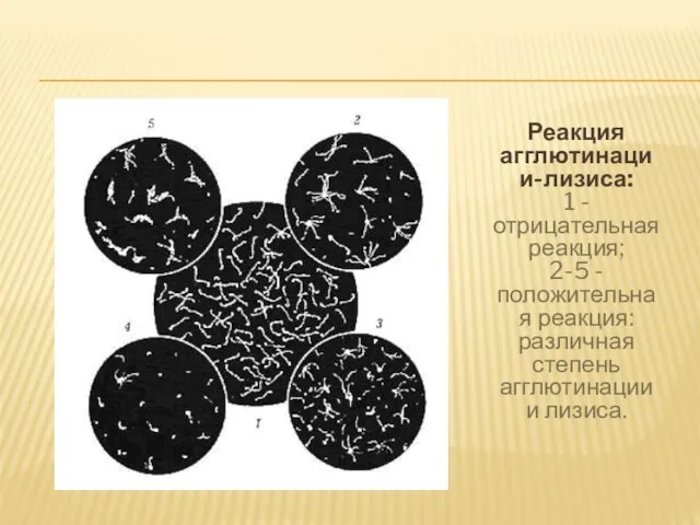 Реакция агглютинации-лизиса: 1 - отрицательная реакция; 2-5 - положительная реакция: различная степень агглютинации и лизиса.