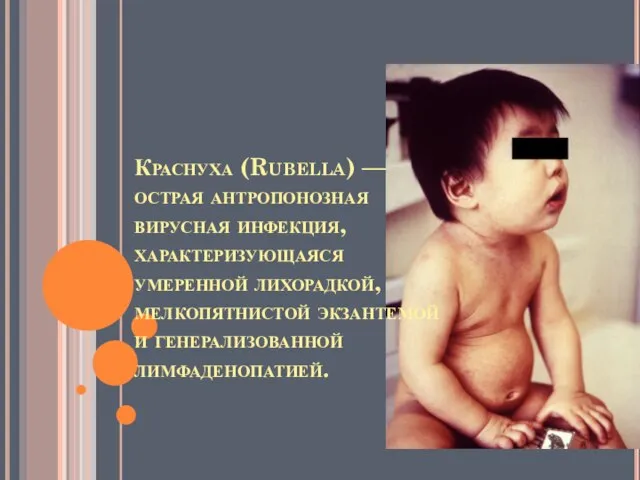 Краснуха (Rubella) — острая антропонозная вирусная инфекция, характеризующаяся умеренной лихорадкой, мелкопятнистой экзантемой и генерализованной лимфаденопатией.