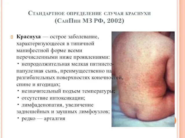 Стандартное определение случая краснухи (СанПин МЗ РФ, 2002) Краснуха — острое