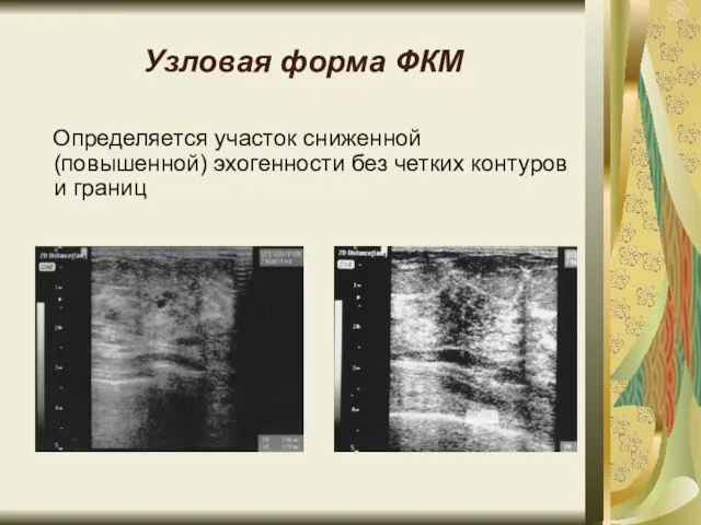 Узловая форма ФКМ Определяется участок сниженной (повышенной) эхогенности без четких контуров и границ