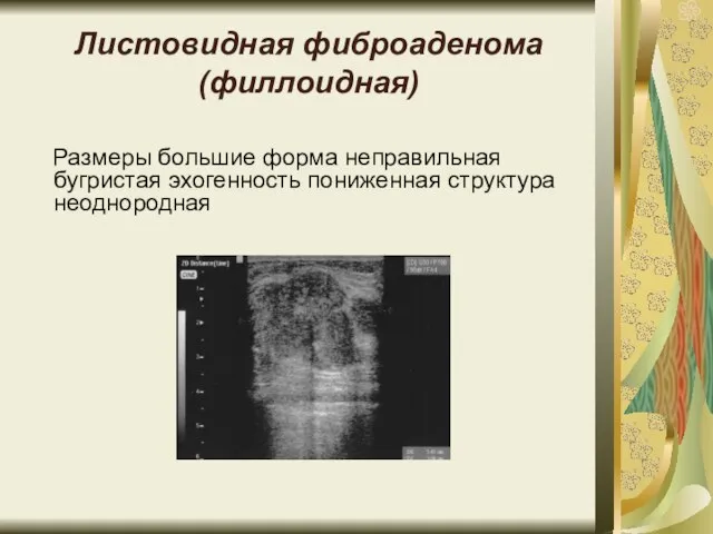 Листовидная фиброаденома (филлоидная) Размеры большие форма неправильная бугристая эхогенность пониженная структура неоднородная