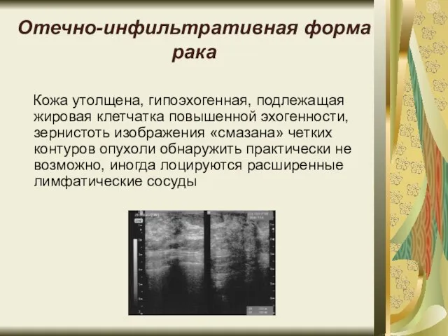 Отечно-инфильтративная форма рака Кожа утолщена, гипоэхогенная, подлежащая жировая клетчатка повышенной эхогенности,