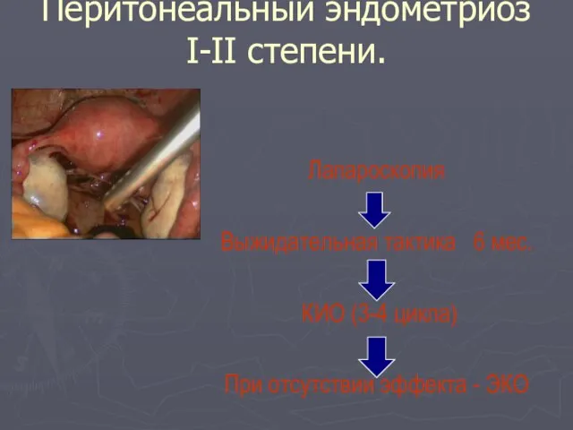 Перитонеальный эндометриоз I-II степени. Лапароскопия Выжидательная тактика 6 мес. КИО (3-4