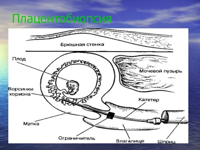 Плацентобиопсия