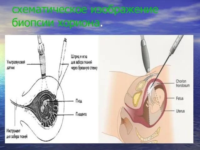 схематическое изображение биопсии хориона.