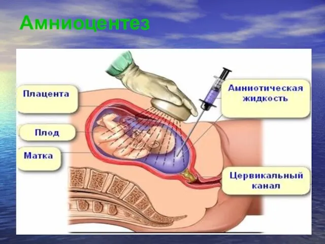 Амниоцентез