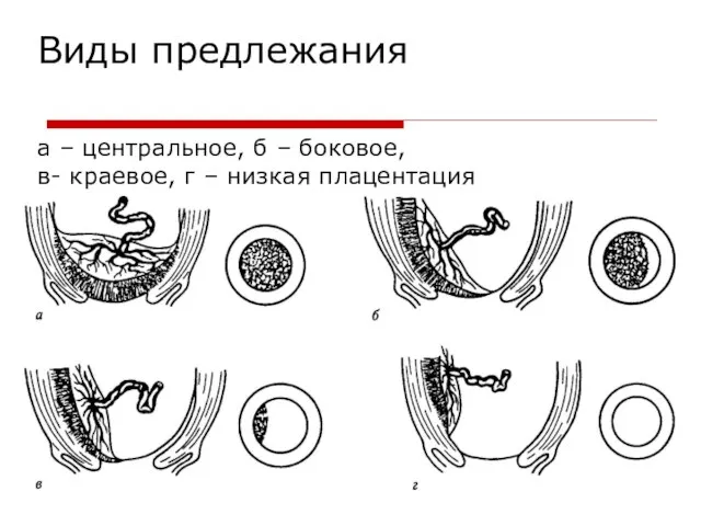 Виды предлежания а – центральное, б – боковое, в- краевое, г – низкая плацентация