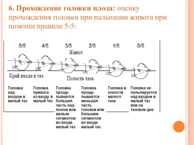 6. Прохождение головки плода: оценку прохождения головки при пальпации живота при помощи правила 5-5: