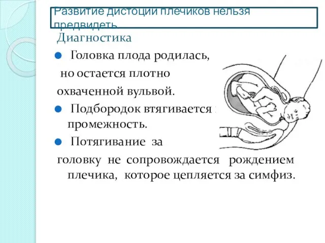 Развитие дистоции плечиков нельзя предвидеть. Диагностика Головка плода родилась, но остается