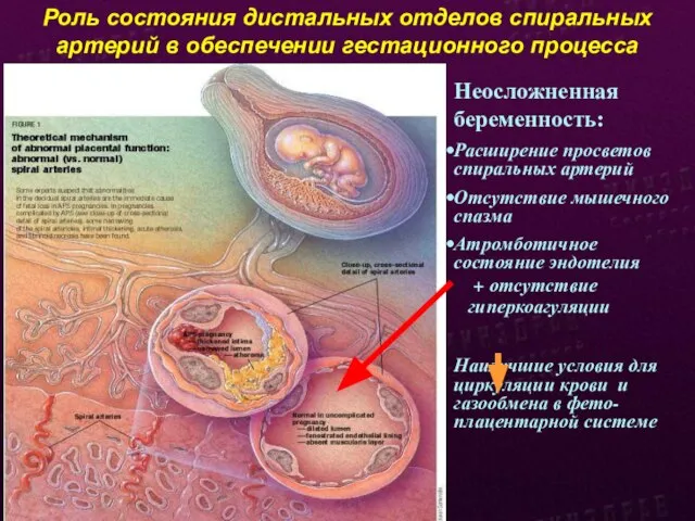 Роль состояния дистальных отделов спиральных артерий в обеспечении гестационного процесса Неосложненная