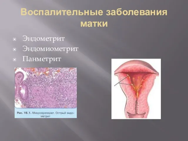 Воспалительные заболевания матки Эндометрит Эндомиометрит Панметрит