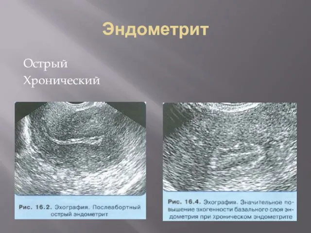 Эндометрит Острый Хронический