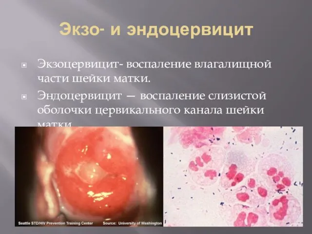 Экзо- и эндоцервицит Экзоцервицит- воспаление влагалищной части шейки матки. Эндоцервицит —