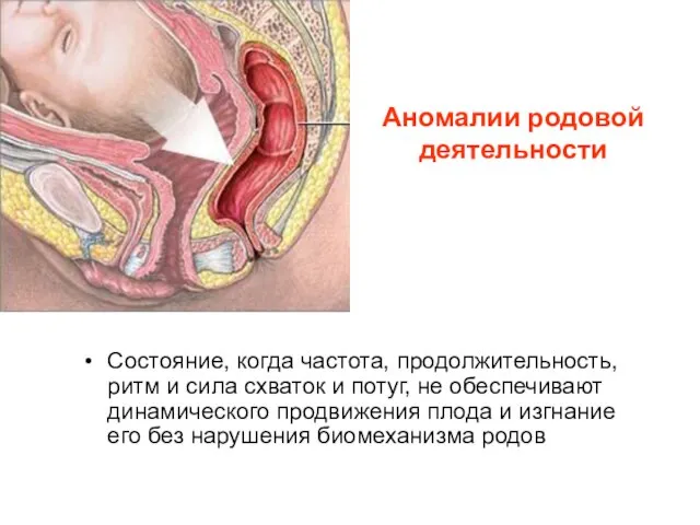 Аномалии родовой деятельности Состояние, когда частота, продолжительность, ритм и сила схваток