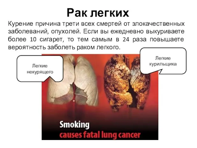 Рак легких Курение причина трети всех смертей от злокачественных заболеваний, опухолей.