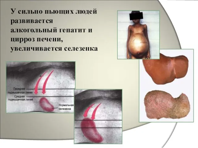 У сильно пьющих людей развивается алкогольный гепатит и цирроз печени, увеличивается селезенка