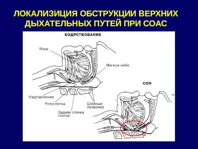 ЛОКАЛИЗИЦИЯ ОБСТРУКЦИИ ВЕРХНИХ ДЫХАТЕЛЬНЫХ ПУТЕЙ ПРИ СОАС