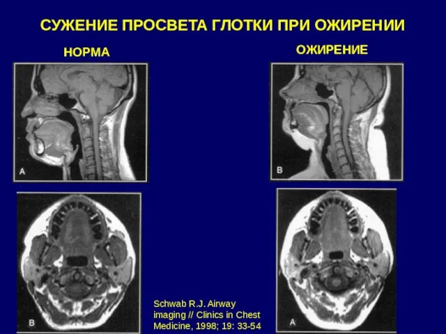 НОРМА ОЖИРЕНИЕ СУЖЕНИЕ ПРОСВЕТА ГЛОТКИ ПРИ ОЖИРЕНИИ Schwab R.J. Airway imaging