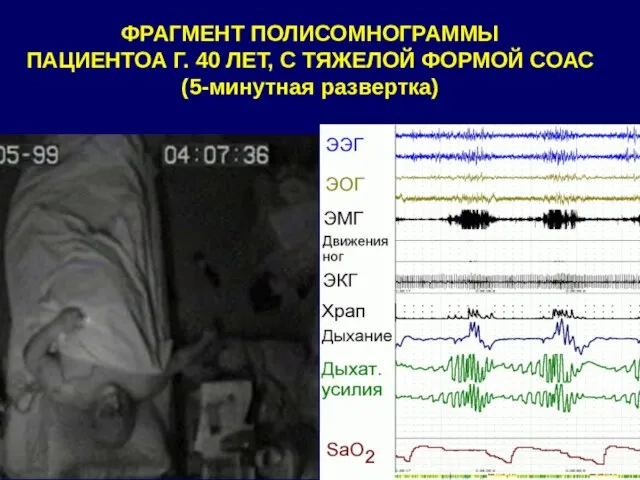 ФРАГМЕНТ ПОЛИСОМНОГРАММЫ ПАЦИЕНТОА Г. 40 ЛЕТ, С ТЯЖЕЛОЙ ФОРМОЙ СОАС (5-минутная развертка)