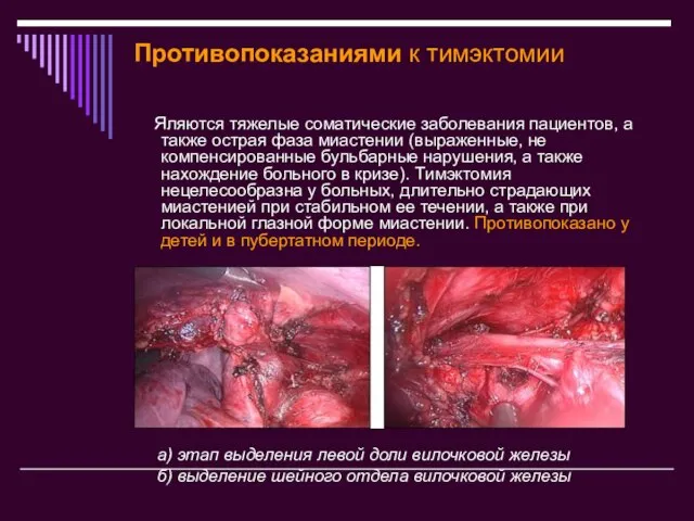 Противопоказаниями к тимэктомии Яляются тяжелые соматические заболевания пациентов, а также острая