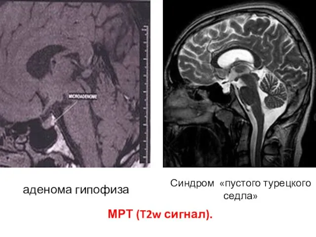 аденома гипофиза Синдром «пустого турецкого седла» МРТ (T2w сигнал).