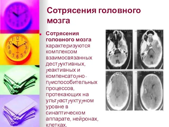 Сотрясения головного мозга Сотрясения головного мозга характеризуются комплексом взаимосвязанных дестpуктивных, pеактивных